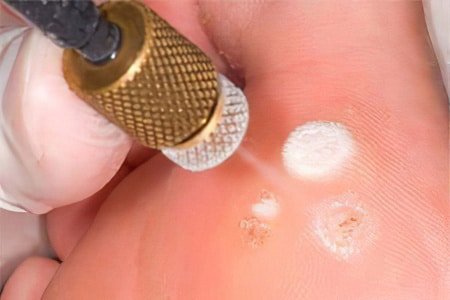 Cryotherapy for Plantar Warts: My 60-Day Post-Procedure Experience 2 plantar wart cryotherapy removal